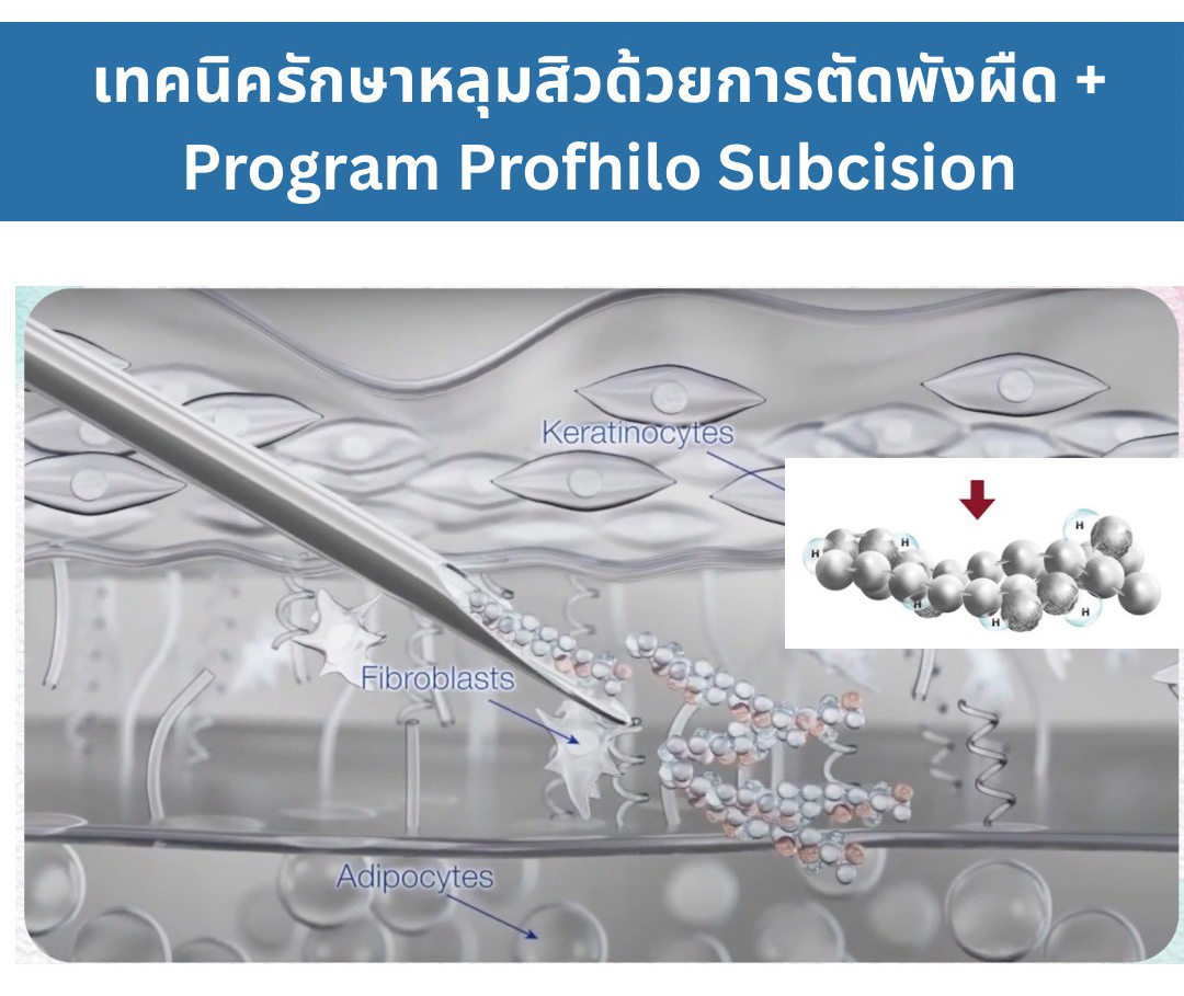 เทคนิครักษาหลุมสิว ด้วยการตัดพังผืดหลุมสิวเทคนิค Program Profhilo Bio-Remodeling Fanning Subcision Techniques for Acne Scar Treatment