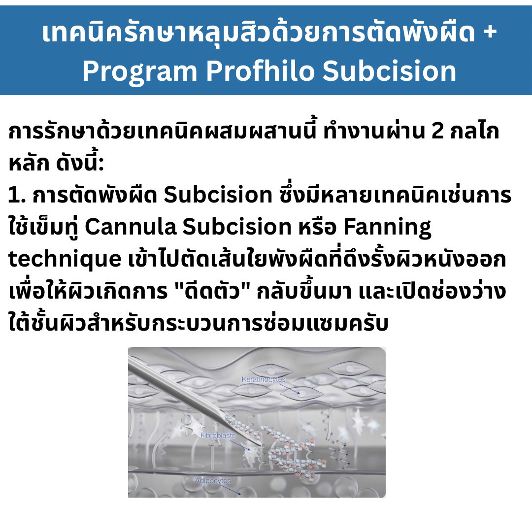 เทคนิครักษาหลุมสิว ด้วยการตัดพังผืดหลุมสิวเทคนิค Program Profhilo Bio-Remodeling Fanning Subcision Techniques for Acne Scar Treatment