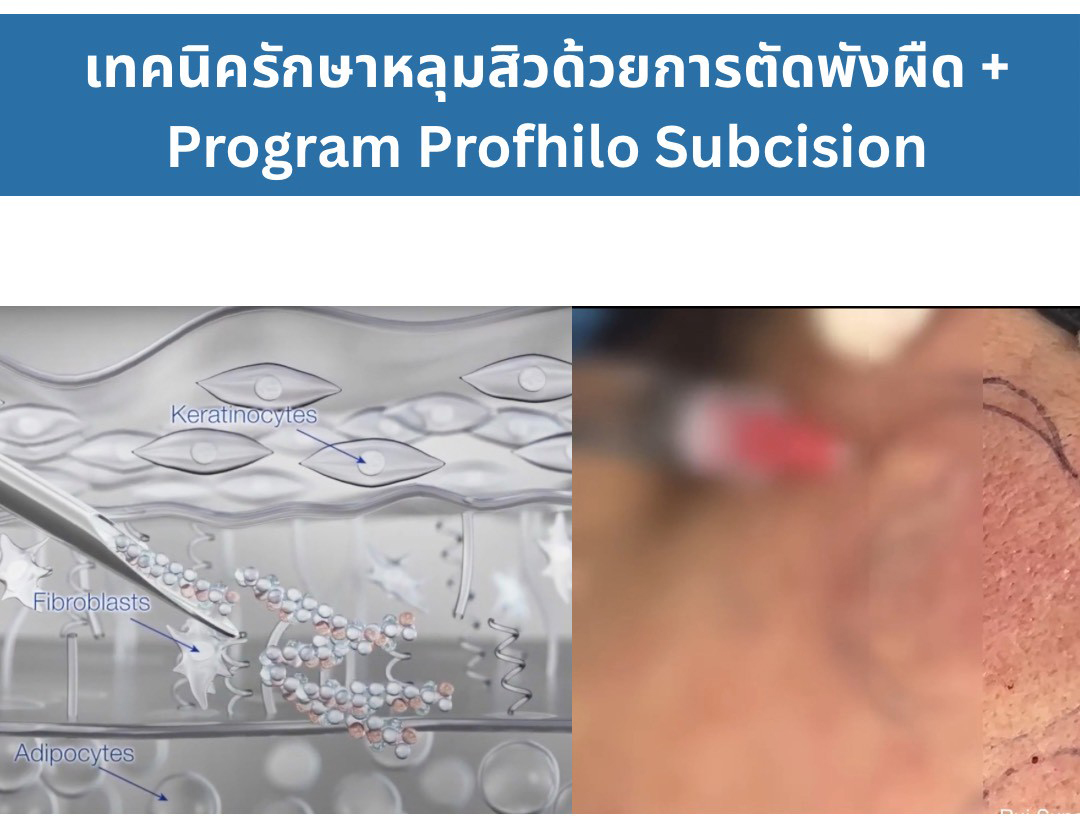 เทคนิครักษาหลุมสิว ด้วยการตัดพังผืดหลุมสิวเทคนิค Program Profhilo Bio-Remodeling Fanning Subcision Techniques for Acne Scar Treatment เทคนิครักษาหลุมสิว ด้วยการตัดพังผืดหลุมสิวเทคนิค Program Profhilo Bio-Remodeling Fanning Subcision Techniques for Acne Scar Treatment