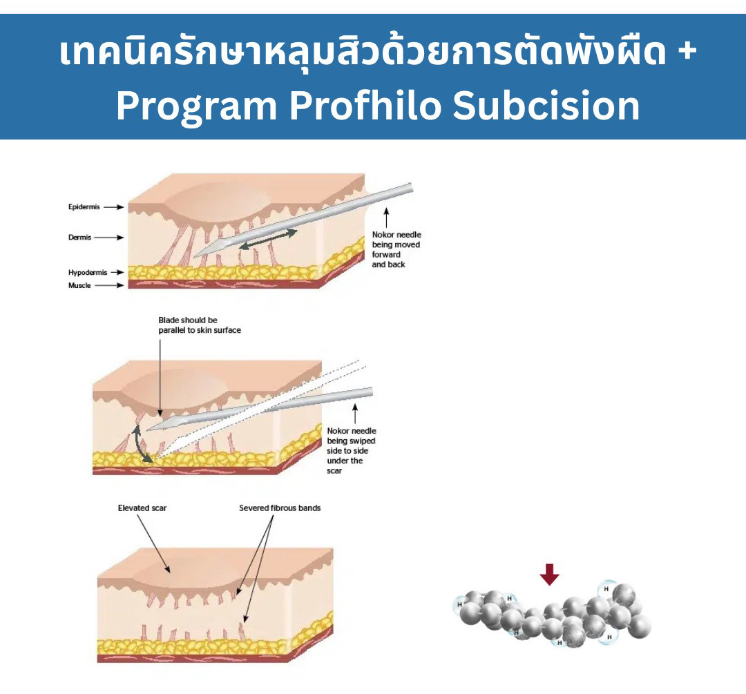 การรักษาหลุมสิวด้วยเทคนิคผสมผสาน Bio Remodelling HA Hybrid Complex ร่วมกับการตัดพังผืด เทคนิค Fanning Subcision การรักษาหลุมสิวด้วยเทคนิคผสมผสาน Bio Remodelling HA Hybrid Complex ร่วมกับการตัดพังผืด เทคนิค Fanning Subcision