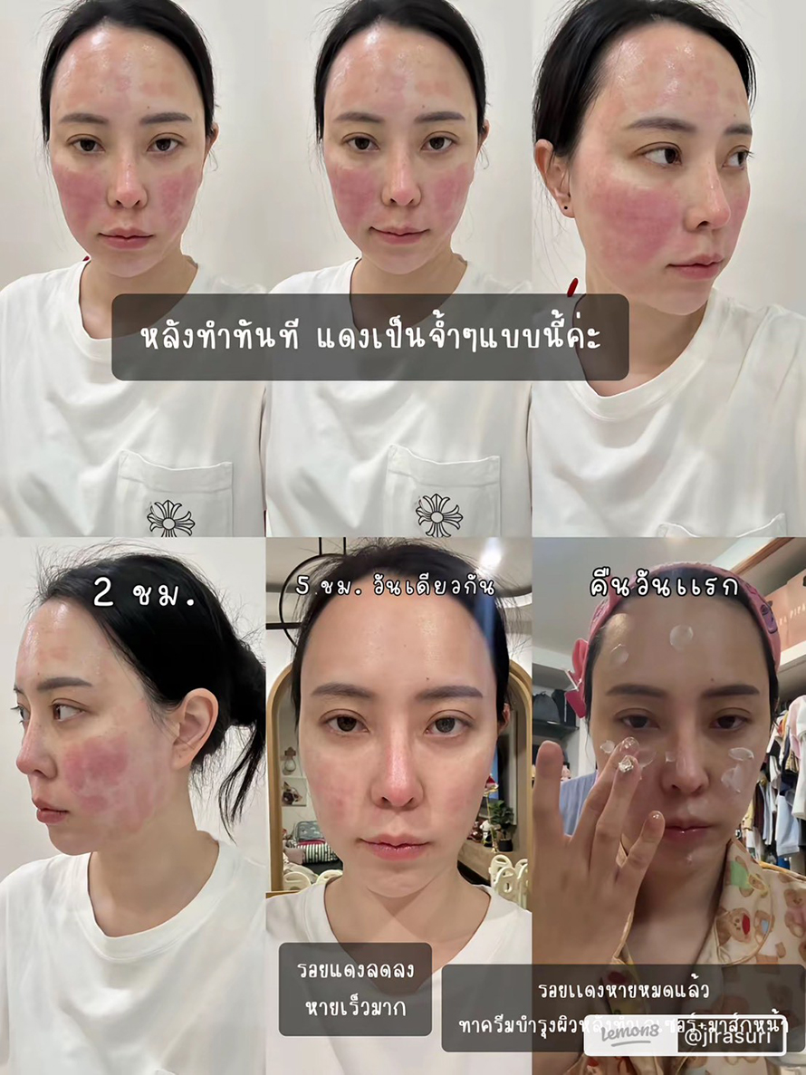 ขอบคุณคุณจูน @jirasuri มากนะครับที่ไว้วางใจให้หมอได้ดูแลปัญหาเรื่องรูขุมขนและจุดด่างดำด้วย โปรแกรม LaserME ครับผม