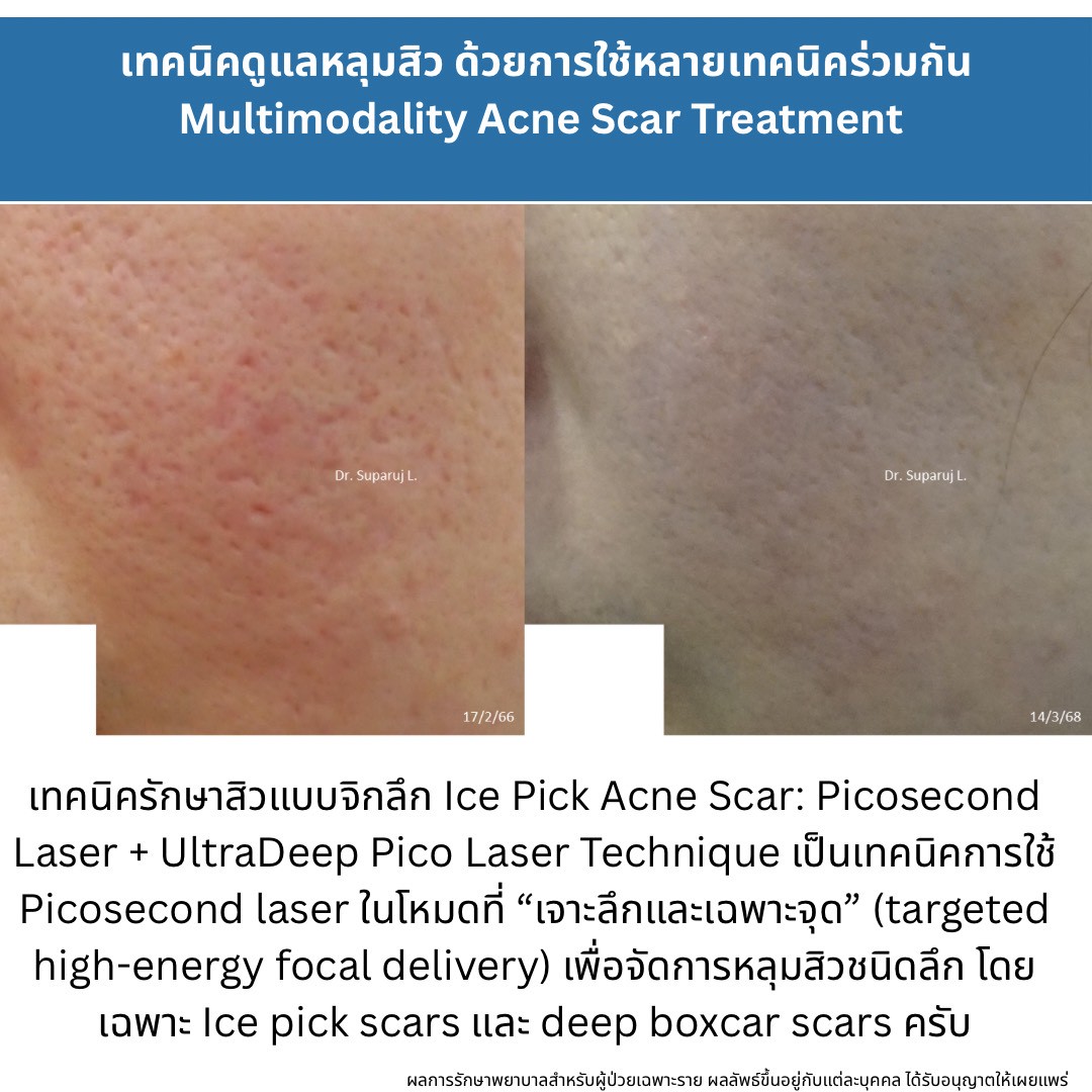 ทำไมต้องใช้เลเซอร์หลายชนิดในการรักษาหลุมสิว แผลเป็น รอยแตกลาย ?