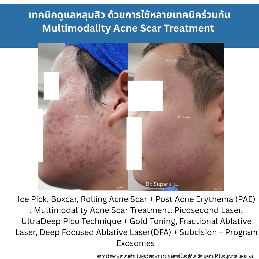 ทำไมต้องใช้เลเซอร์หลายชนิดในการรักษาหลุมสิว แผลเป็น รอยแตกลาย ? ทำไมต้องใช้เลเซอร์หลายชนิดในการรักษาหลุมสิว แผลเป็น รอยแตกลาย ?