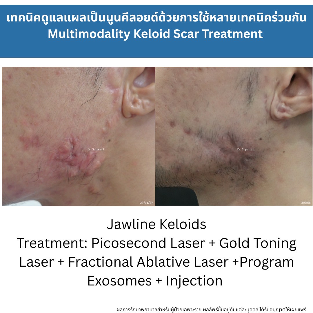 ทำไมต้องใช้เลเซอร์หลายชนิดในการรักษาหลุมสิว แผลเป็น รอยแตกลาย ? ทำไมต้องใช้เลเซอร์หลายชนิดในการรักษาหลุมสิว แผลเป็น รอยแตกลาย ?