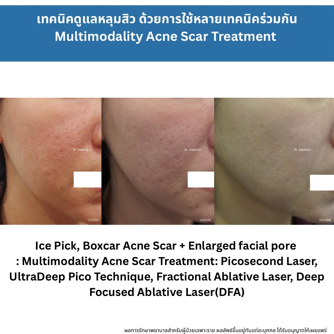 รักษาหลุมสิวแต่พักหน้าไม่ได้ มีวิธีอะไรบ้าง ? How to Treat Acne Scars When You Can’t Afford a Recovery Period แนวทางการรักษาหลุมสิวสำหรับผู้ที่ไม่สามารถพักหน้าได้ (Social Down-time Limited)ครับ. รักษาหลุมสิวแต่พักหน้าไม่ได้ มีวิธีอะไรบ้าง ? How to Treat Acne Scars When You Can’t Afford a Recovery Period แนวทางการรักษาหลุมสิวสำหรับผู้ที่ไม่สามารถพักหน้าได้ (Social Down-time Limited)ครับ.