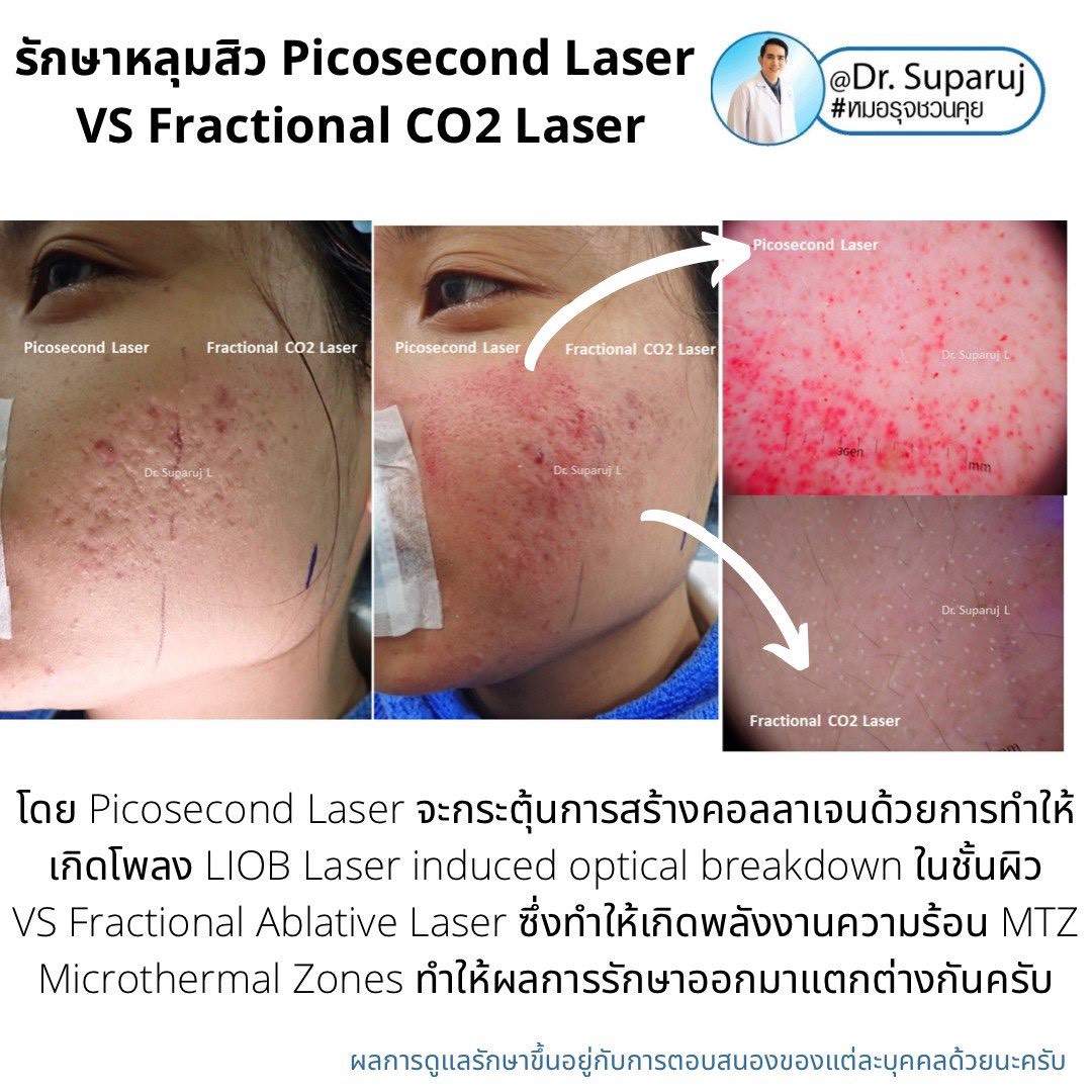 เจาะลึกความแตกต่าง: Fractional CO2 vs Fractional Picosecond Laser ในการรักษาหลุมสิว เจาะลึกความแตกต่าง: Fractional CO2 vs Fractional Picosecond Laser ในการรักษาหลุมสิว