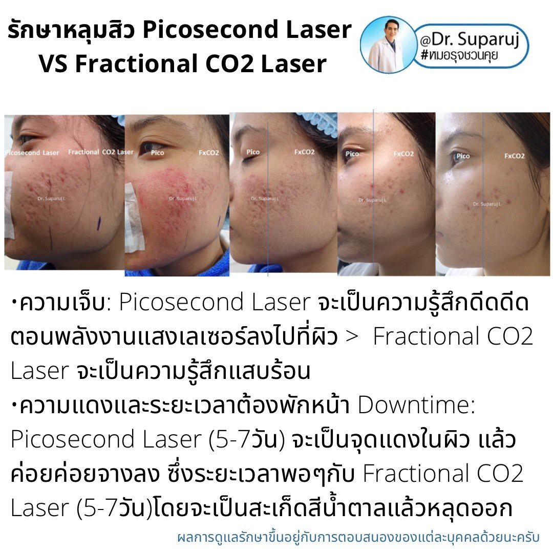 เจาะลึกความแตกต่าง: Fractional CO2 vs Fractional Picosecond Laser ในการรักษาหลุมสิว เจาะลึกความแตกต่าง: Fractional CO2 vs Fractional Picosecond Laser ในการรักษาหลุมสิว