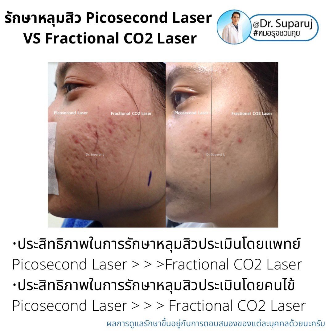 เจาะลึกความแตกต่าง: Fractional CO2 vs Fractional Picosecond Laser ในการรักษาหลุมสิว เจาะลึกความแตกต่าง: Fractional CO2 vs Fractional Picosecond Laser ในการรักษาหลุมสิว