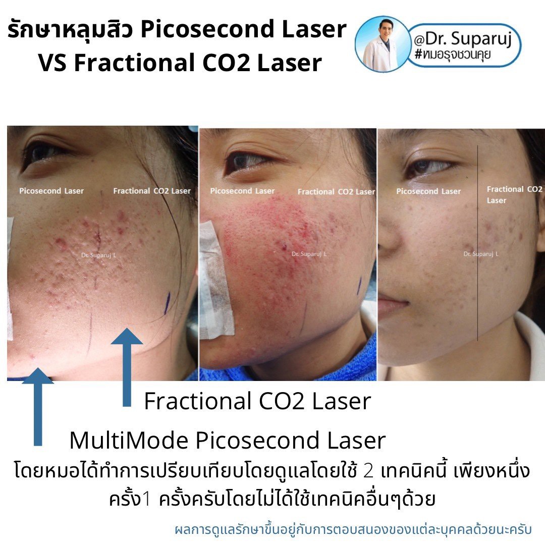 เจาะลึกความแตกต่าง: Fractional CO2 vs Fractional Picosecond Laser ในการรักษาหลุมสิว เจาะลึกความแตกต่าง: Fractional CO2 vs Fractional Picosecond Laser ในการรักษาหลุมสิว