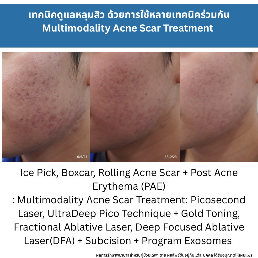 รักษาหลุมสิวแต่พักหน้าไม่ได้ มีวิธีอะไรบ้าง ? How to Treat Acne Scars When You Can’t Afford a Recovery Period แนวทางการรักษาหลุมสิวสำหรับผู้ที่ไม่สามารถพักหน้าได้ (Social Down-time Limited)ครับ. รักษาหลุมสิวแต่พักหน้าไม่ได้ มีวิธีอะไรบ้าง ? How to Treat Acne Scars When You Can’t Afford a Recovery Period แนวทางการรักษาหลุมสิวสำหรับผู้ที่ไม่สามารถพักหน้าได้ (Social Down-time Limited)ครับ.