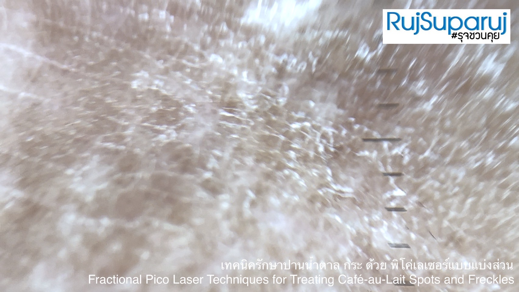 เทคนิครักษาปานน้ำตาล กระ ด้วย พิโค่เลเซอร์แบบแบ่งส่วน Fractional Pico Laser Techniques for Treating Café-au-Lait Spots and Freckles เทคนิครักษาปานน้ำตาล กระ ด้วย พิโค่เลเซอร์แบบแบ่งส่วน Fractional Pico Laser Techniques for Treating Café-au-Lait Spots and Freckles