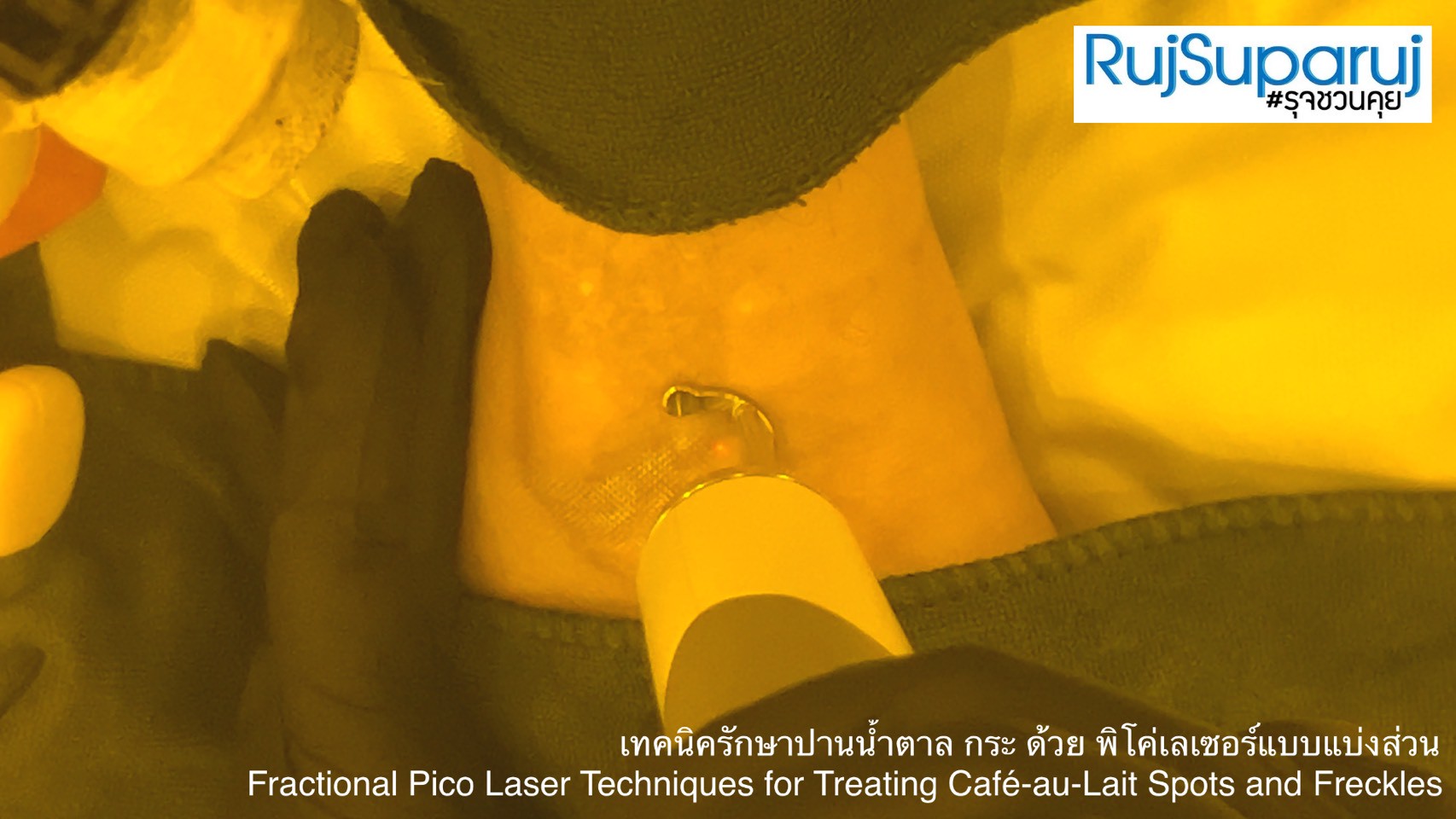 เทคนิครักษาปานน้ำตาล กระ ด้วย พิโค่เลเซอร์แบบแบ่งส่วน Fractional Pico Laser Techniques for Treating Café-au-Lait Spots and Freckles