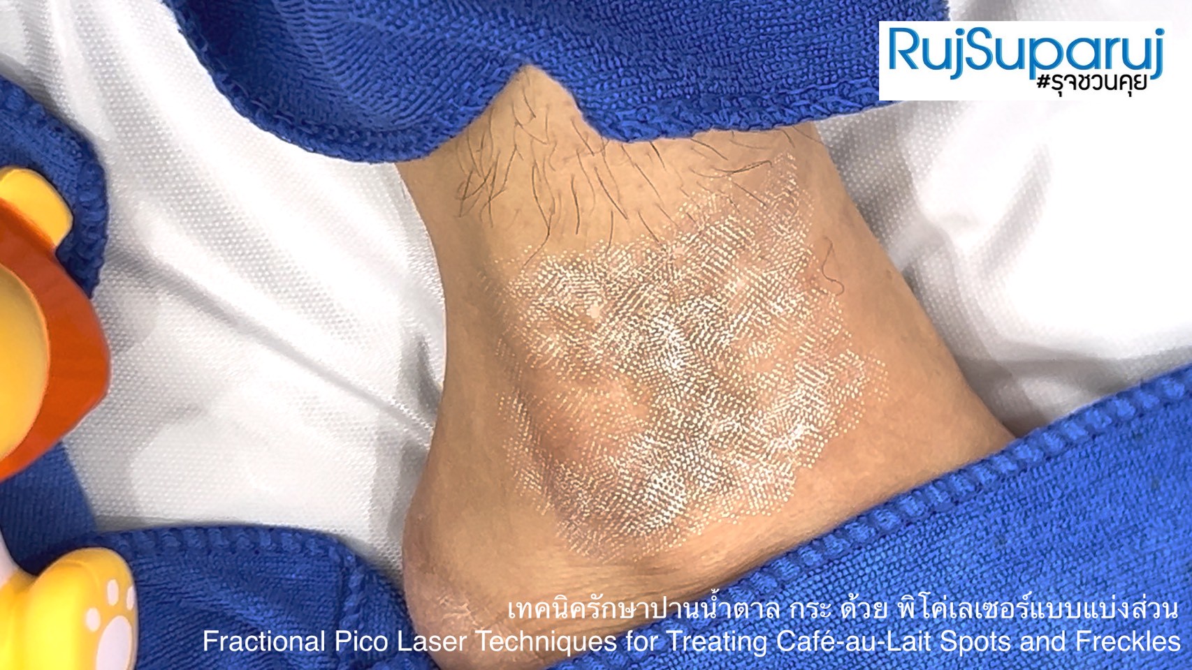 เทคนิครักษาปานน้ำตาล กระ ด้วย พิโค่เลเซอร์แบบแบ่งส่วน Fractional Pico Laser Techniques for Treating Café-au-Lait Spots and Freckles