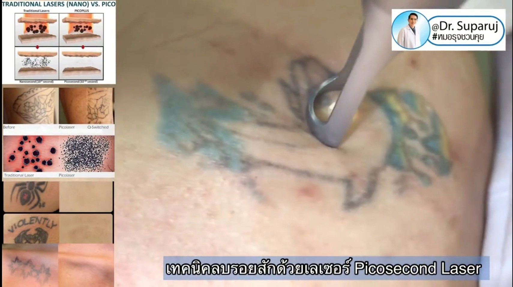 เทคนิคลบรอยสักด้วยเลเซอร์ Picosecond Laser