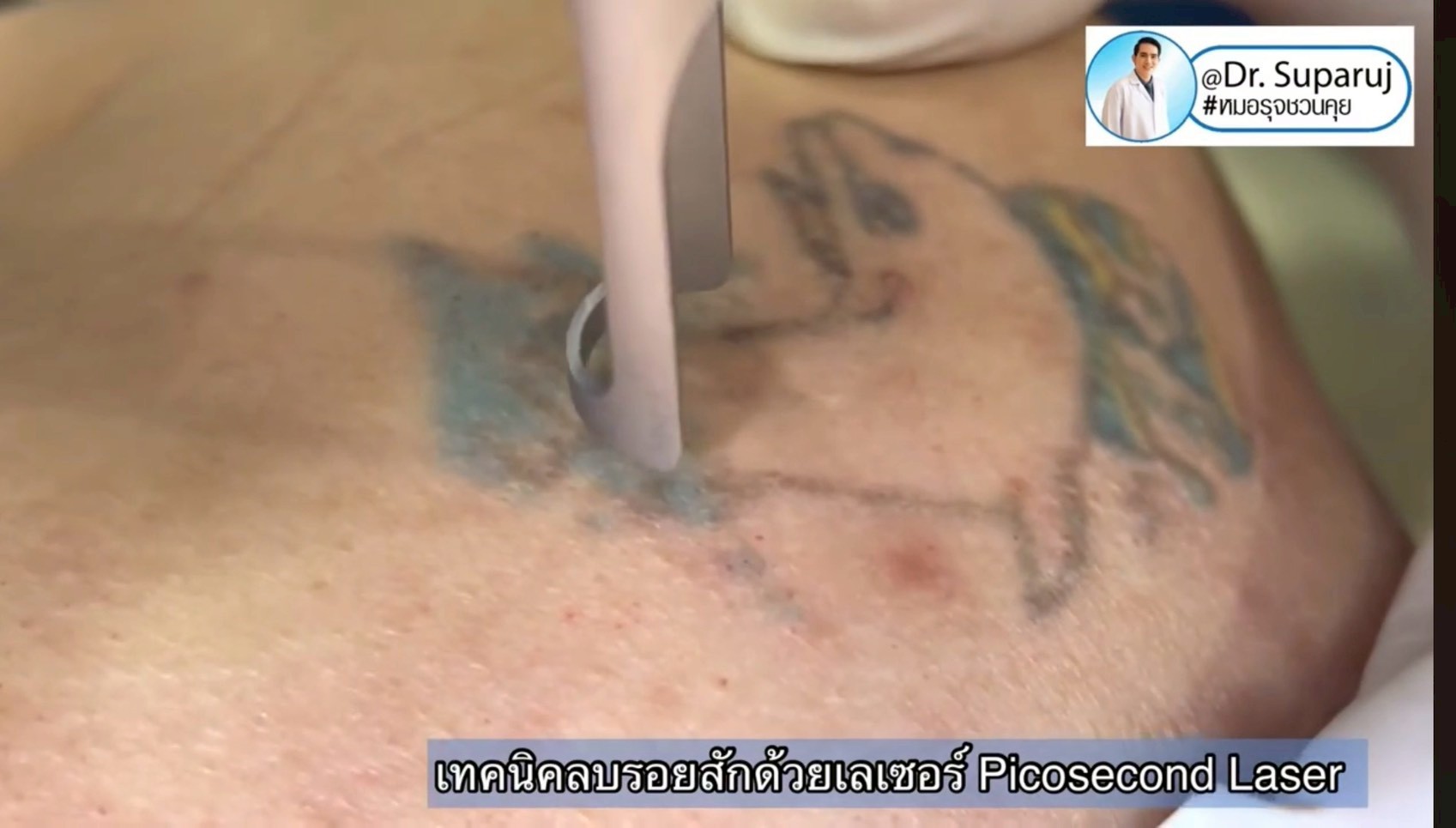 เทคนิคลบรอยสักด้วยเลเซอร์ Picosecond Laser เทคนิคลบรอยสักด้วยเลเซอร์ Picosecond Laser