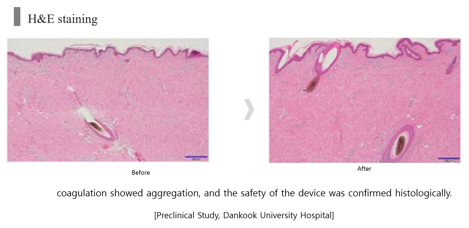 เทคนิค ยกกระชับใบหน้าและคิ้วด้วย เทคนิค Triple-Lined Multifocused Ultrasound เทคนิค ยกกระชับใบหน้าและคิ้วด้วย เทคนิค Triple-Lined Multifocused Ultrasound