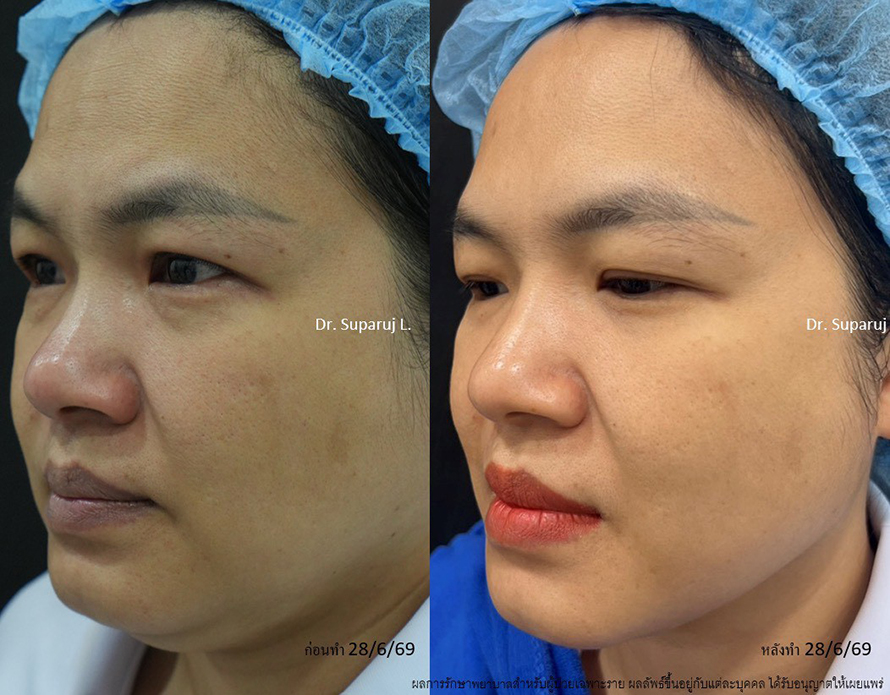 แนะนำโปรแกรมยกกระชับผิวด้วยเลเซอร์ หลายความยาวคลื่น Program Platinum Lifting Multi-Wavelength Laser แนะนำโปรแกรมยกกระชับผิวด้วยเลเซอร์ หลายความยาวคลื่น Program Platinum Lifting Multi-Wavelength Laser