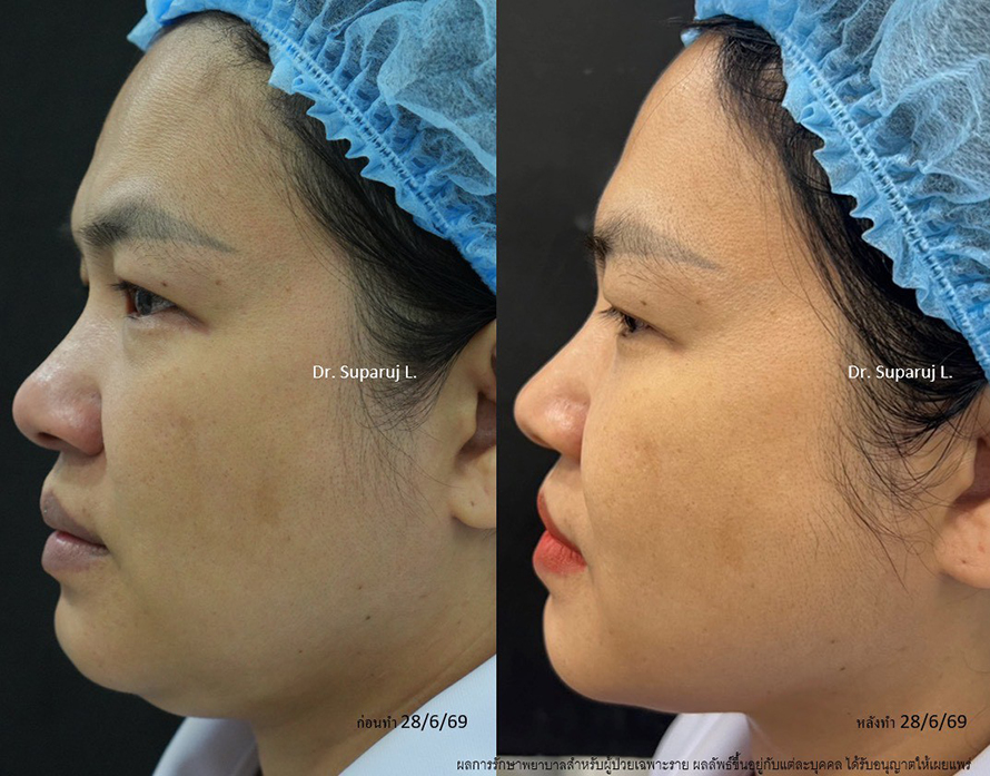 แนะนำโปรแกรมยกกระชับผิวด้วยเลเซอร์ หลายความยาวคลื่น Program Platinum Lifting Multi-Wavelength Laser