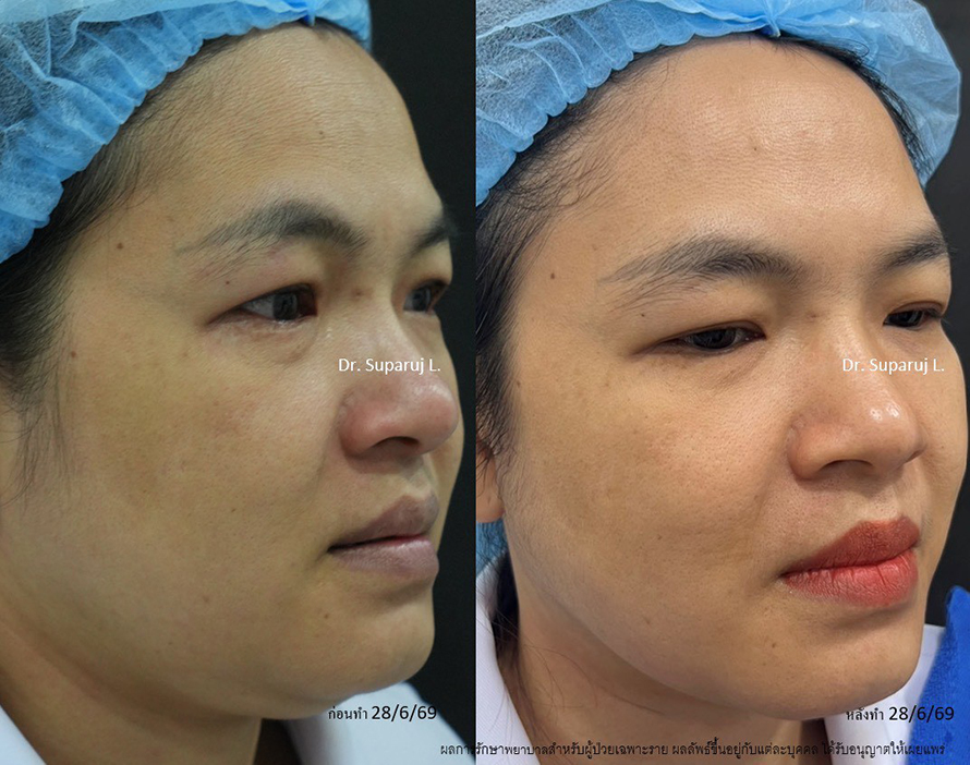 แนะนำโปรแกรมยกกระชับผิวด้วยเลเซอร์ หลายความยาวคลื่น Program Platinum Lifting Multi-Wavelength Laser