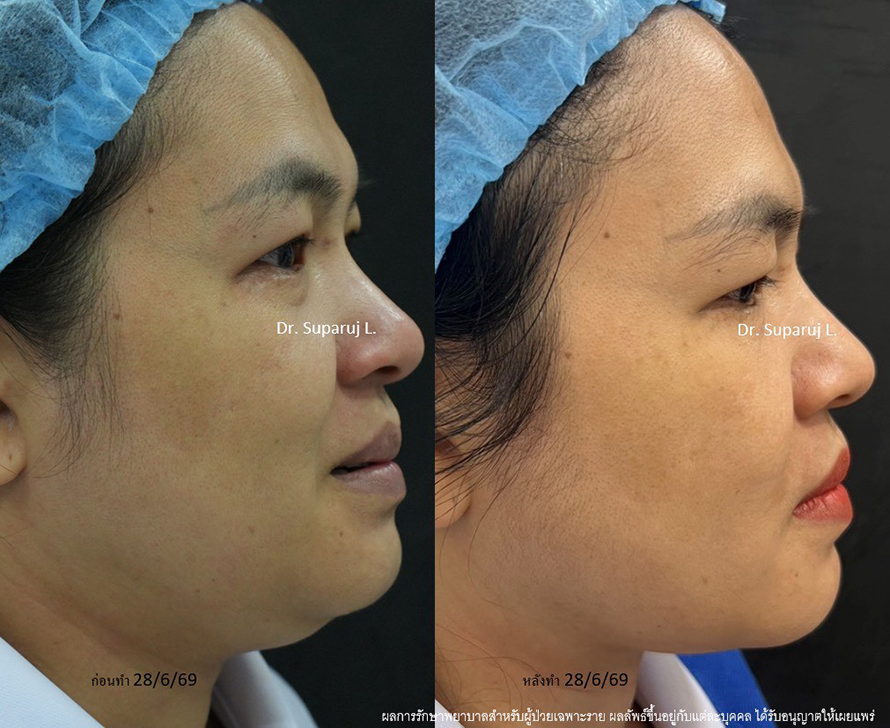 แนะนำโปรแกรมยกกระชับผิวด้วยเลเซอร์ หลายความยาวคลื่น Program Platinum Lifting Multi-Wavelength Laser แนะนำโปรแกรมยกกระชับผิวด้วยเลเซอร์ หลายความยาวคลื่น Program Platinum Lifting Multi-Wavelength Laser