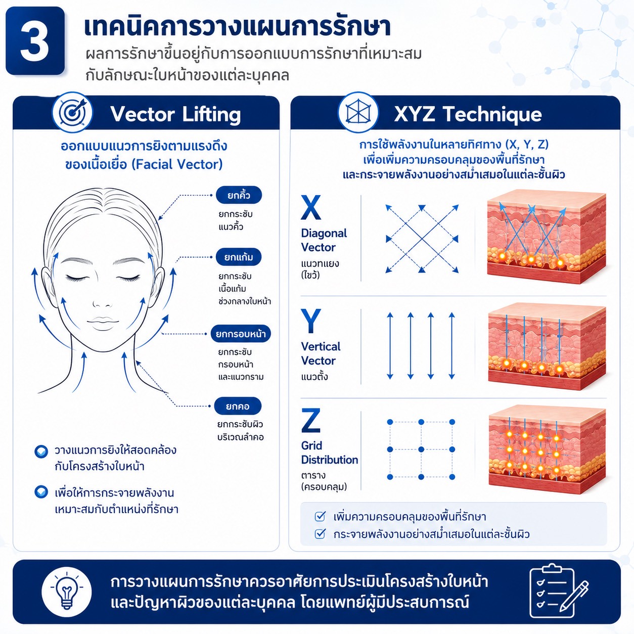 เทคนิคการยกกระชับใบหน้าและคิ้วด้วย Triple-Lined Multifocused Ultrasound: โปรแกรม X-Triple