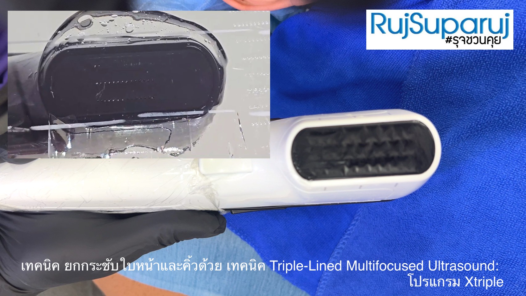 เทคนิคการยกกระชับใบหน้าและคิ้วด้วย Triple-Lined Multifocused Ultrasound: โปรแกรม X-Triple