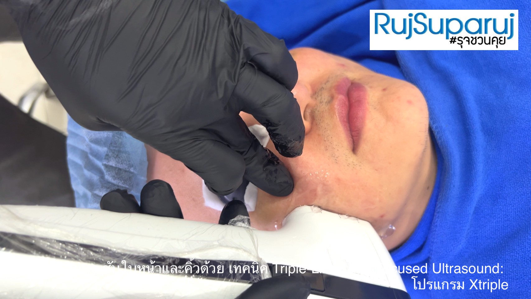 เทคนิคการยกกระชับใบหน้าและคิ้วด้วย Triple-Lined Multifocused Ultrasound: โปรแกรม X-Triple