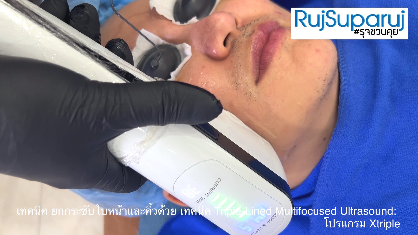 เทคนิคการยกกระชับใบหน้าและคิ้วด้วย Triple-Lined Multifocused Ultrasound: โปรแกรม X-Triple