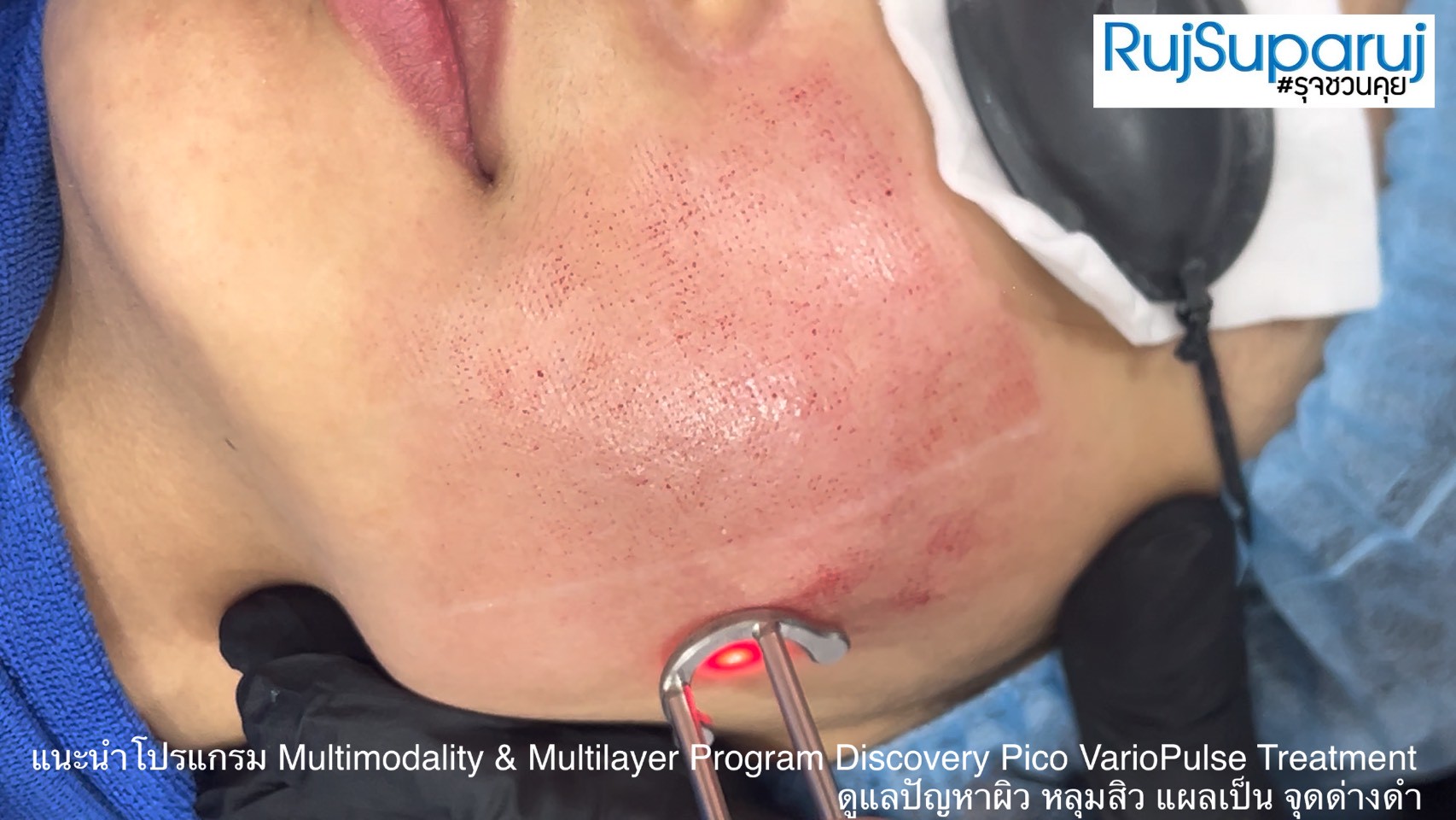 แนะนำโปรแกรม Multimodality & Multilayer Program Discovery Pico VarioPulse Treatment ดูแลปัญหาผิว หลุมสิว แผลเป็น จุดด่างดำ