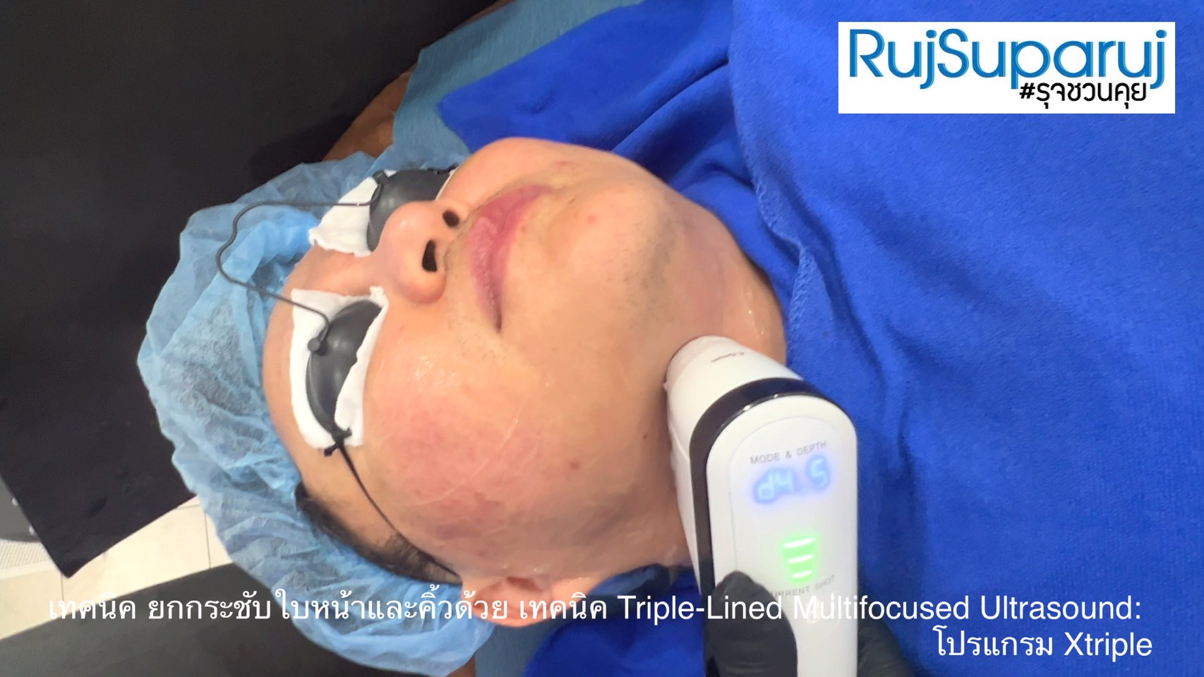 เทคนิคการยกกระชับใบหน้าและคิ้วด้วย Triple-Lined Multifocused Ultrasound: โปรแกรม X-Triple