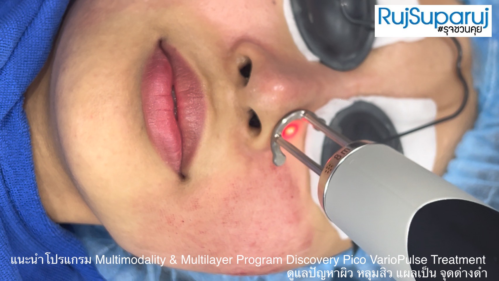 แนะนำโปรแกรม Multimodality & Multilayer Program Discovery Pico VarioPulse Treatment ดูแลปัญหาผิว หลุมสิว แผลเป็น จุดด่างดำ