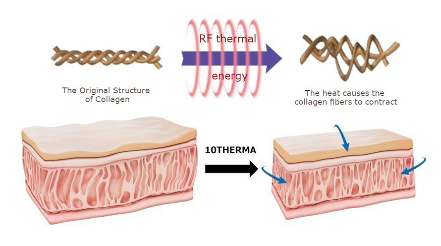 การดูแลความกระชับของผิวด้วย Program XTherma Monopolar RF