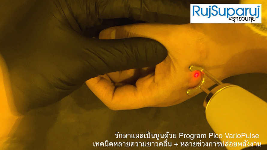 รักษาแผลเป็นนูนด้วย Program Pico VarioPulse เทคนิคหลายความยาวคลื่น + หลายช่วงการปล่อยพลังงาน