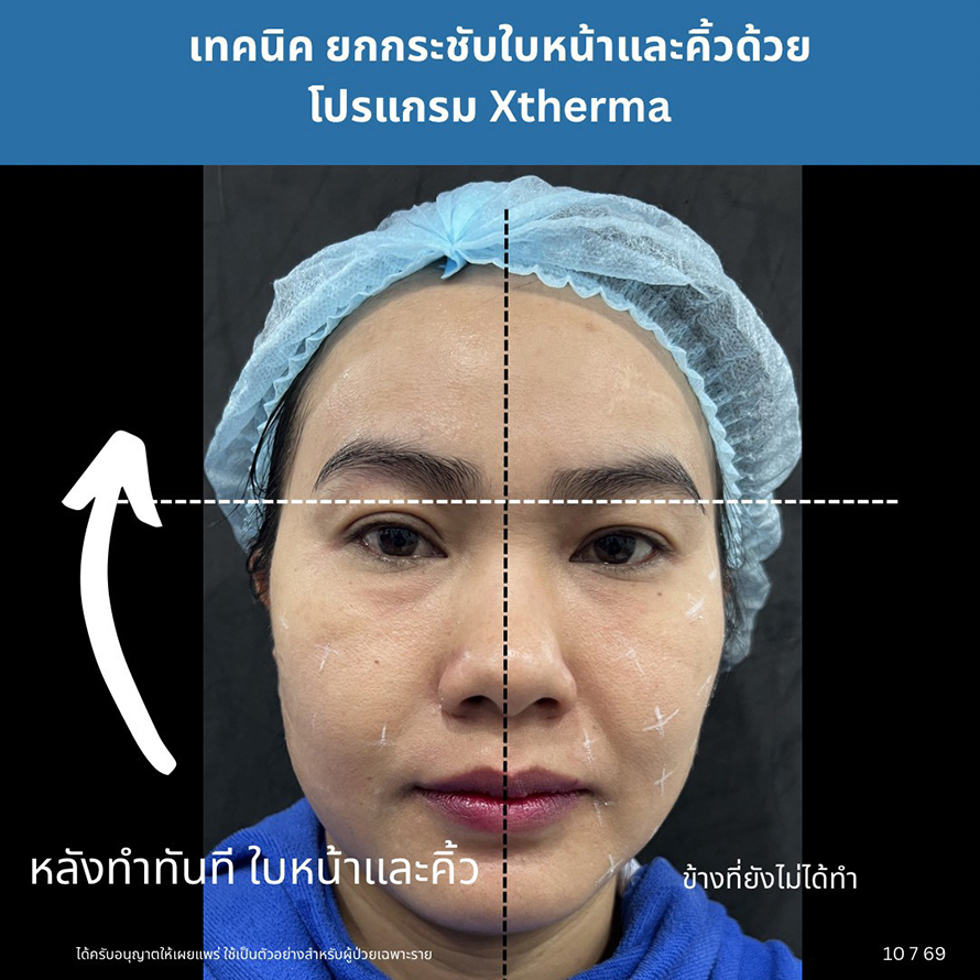 การดูแลความกระชับของผิวด้วย Program XTherma Monopolar RF