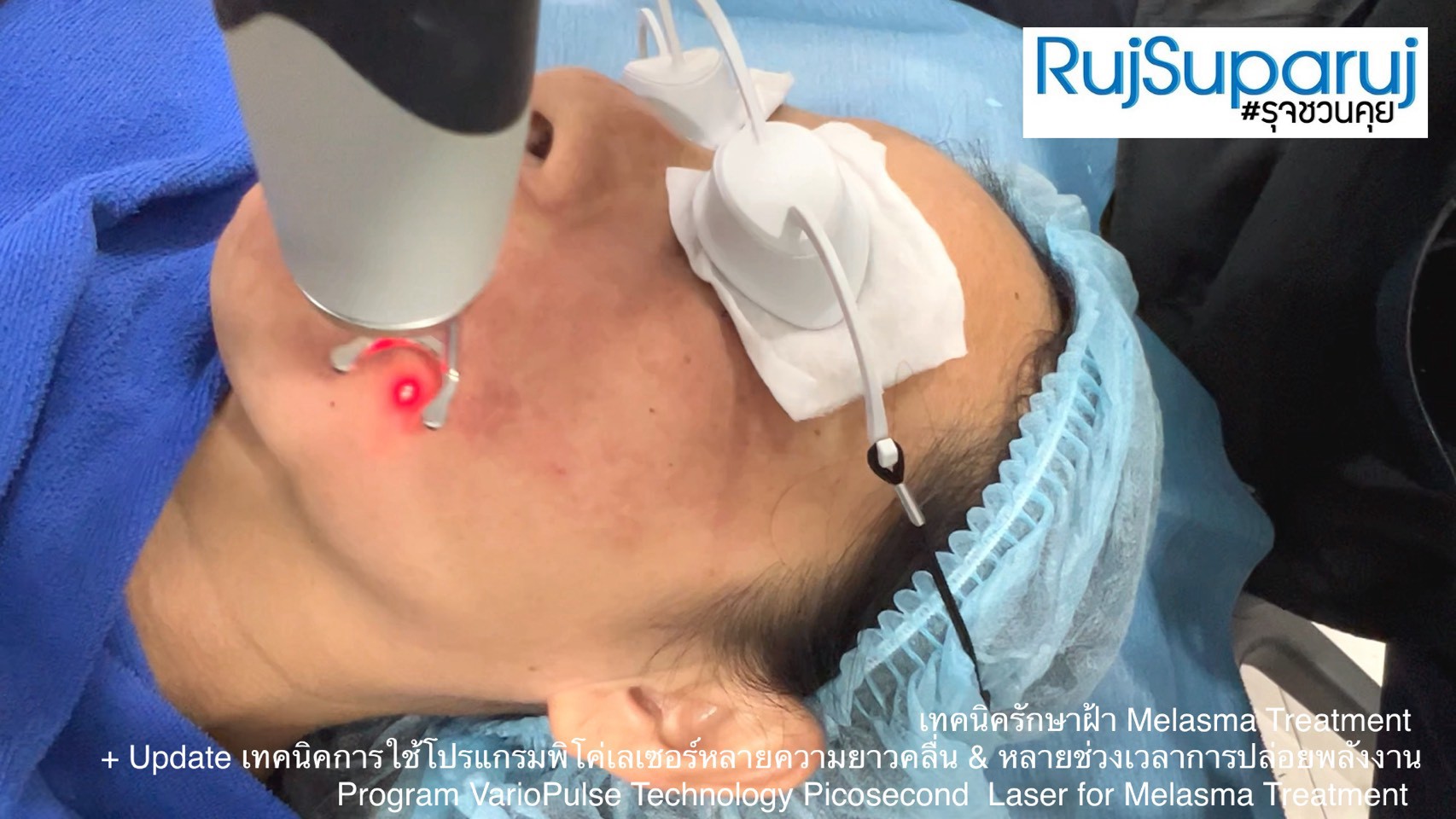Update เทคนิคดูแลปัญหาฝ้า Melasma Treatment Update
