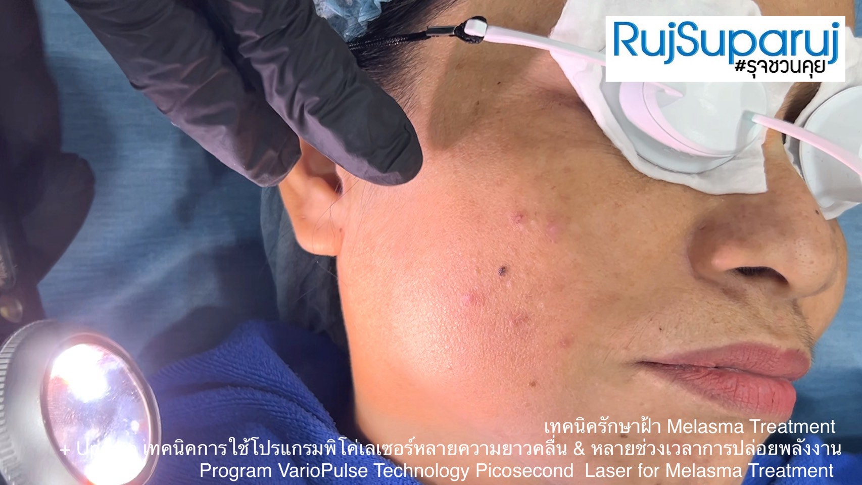 Update เทคนิคดูแลปัญหาฝ้า Melasma Treatment Update Update เทคนิคดูแลปัญหาฝ้า Melasma Treatment Update