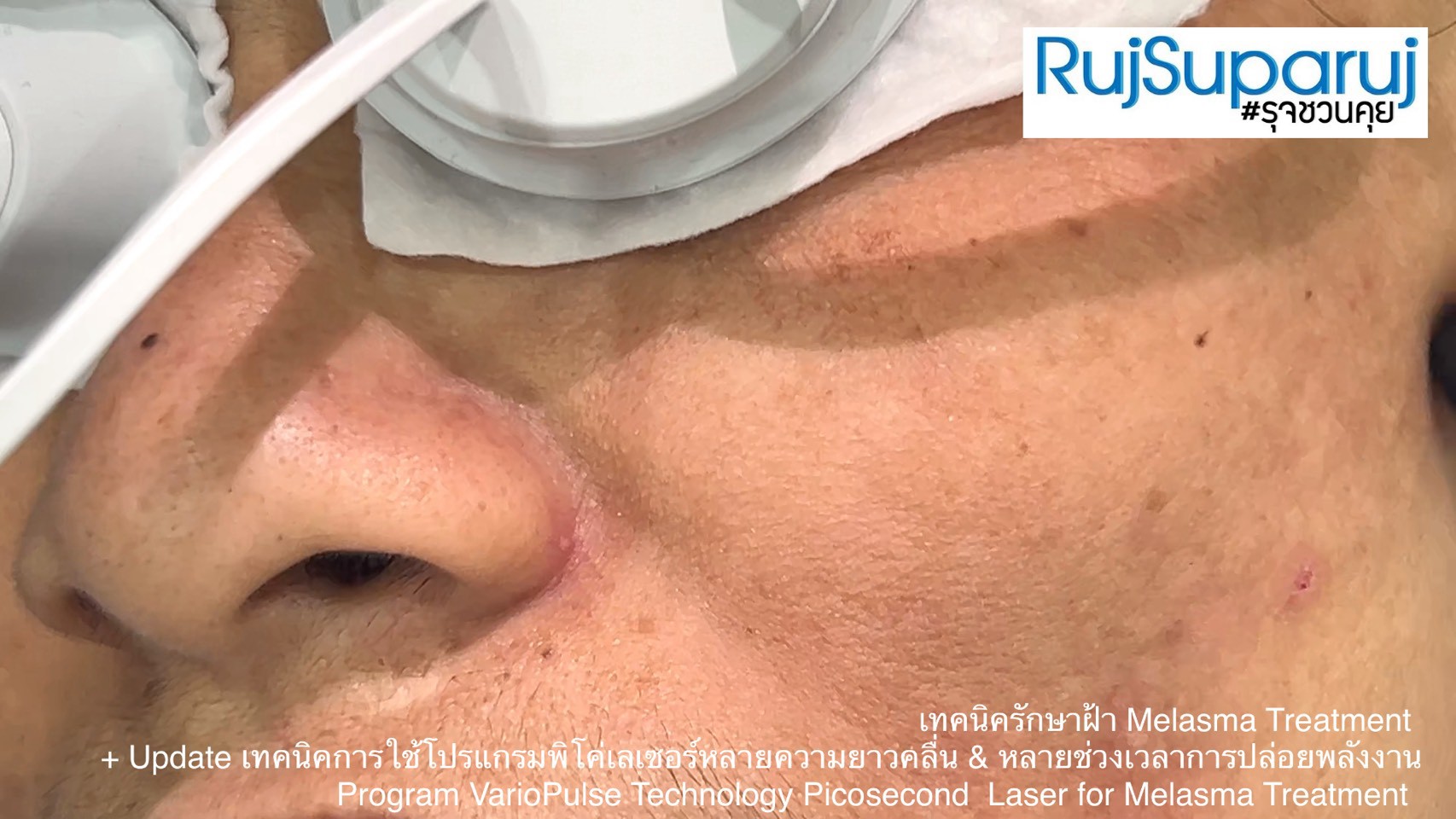 Update เทคนิคดูแลปัญหาฝ้า Melasma Treatment Update