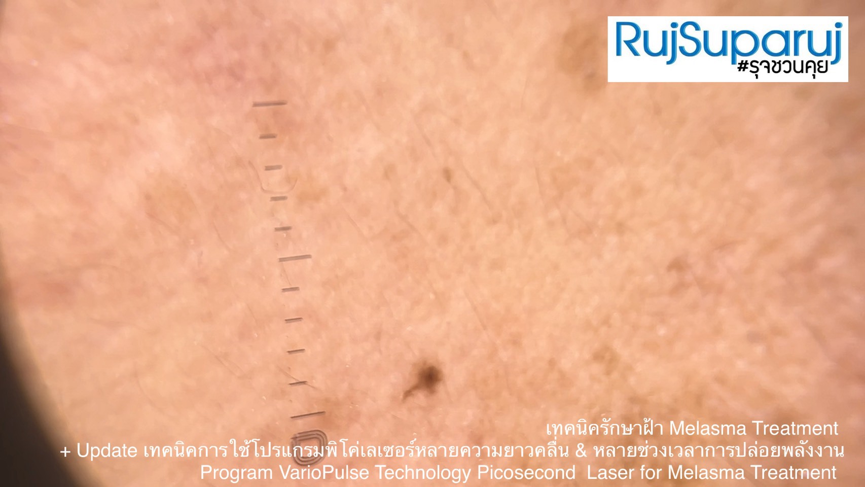 Update เทคนิคดูแลปัญหาฝ้า Melasma Treatment Update