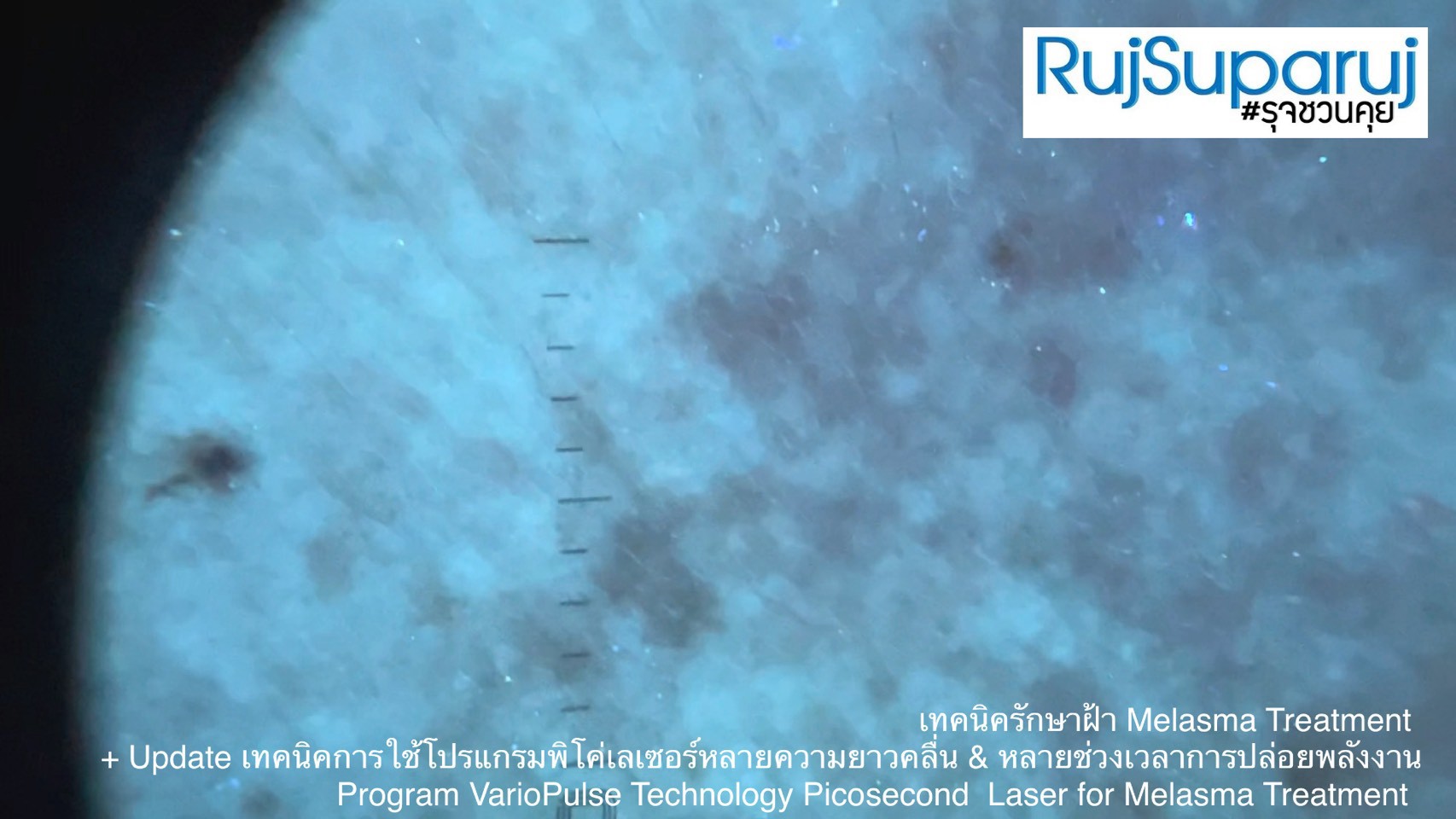 Update เทคนิคดูแลปัญหาฝ้า Melasma Treatment Update Update เทคนิคดูแลปัญหาฝ้า Melasma Treatment Update
