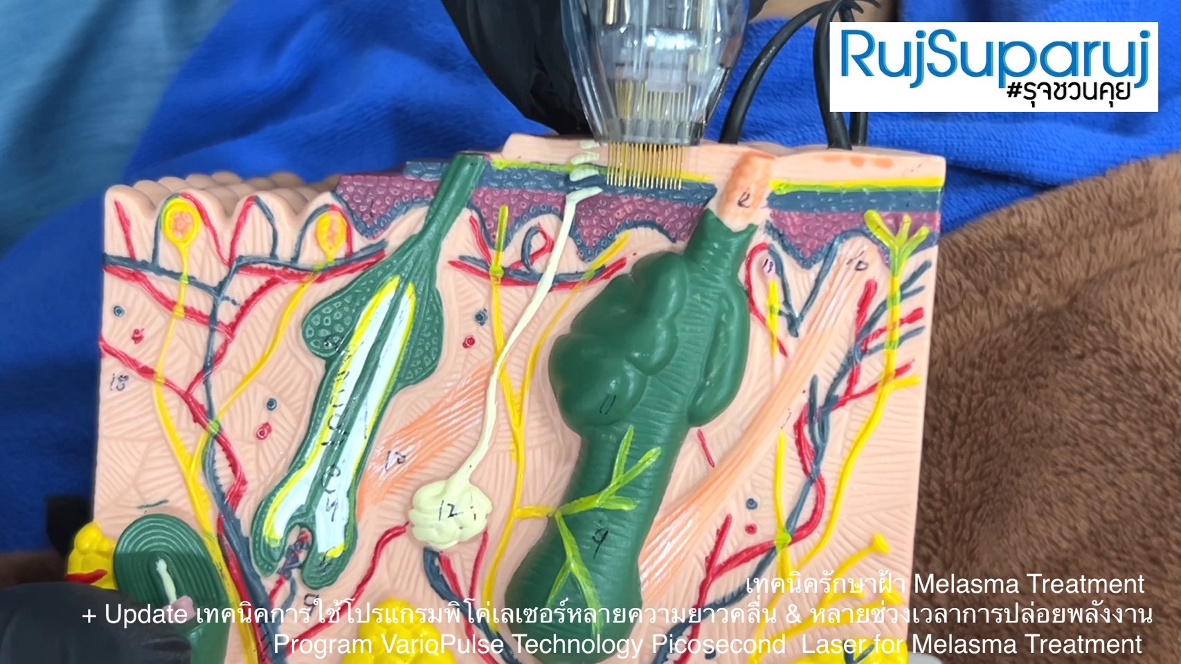Update เทคนิคดูแลปัญหาฝ้า Melasma Treatment Update Update เทคนิคดูแลปัญหาฝ้า Melasma Treatment Update