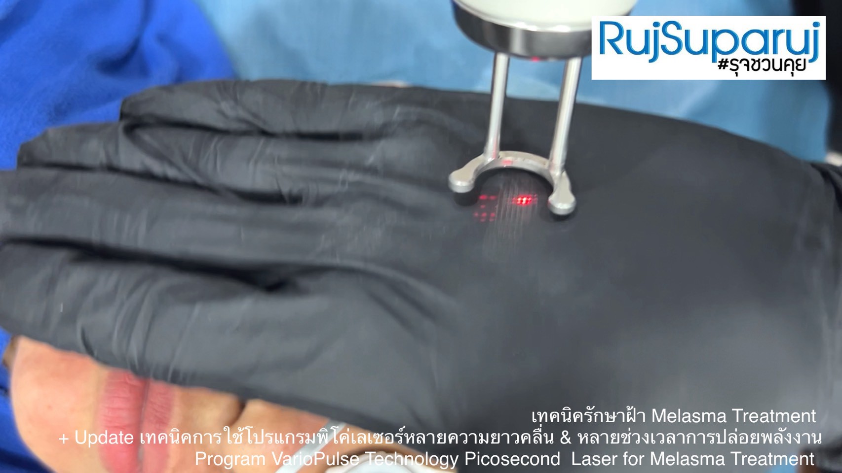Update เทคนิคดูแลปัญหาฝ้า Melasma Treatment Update