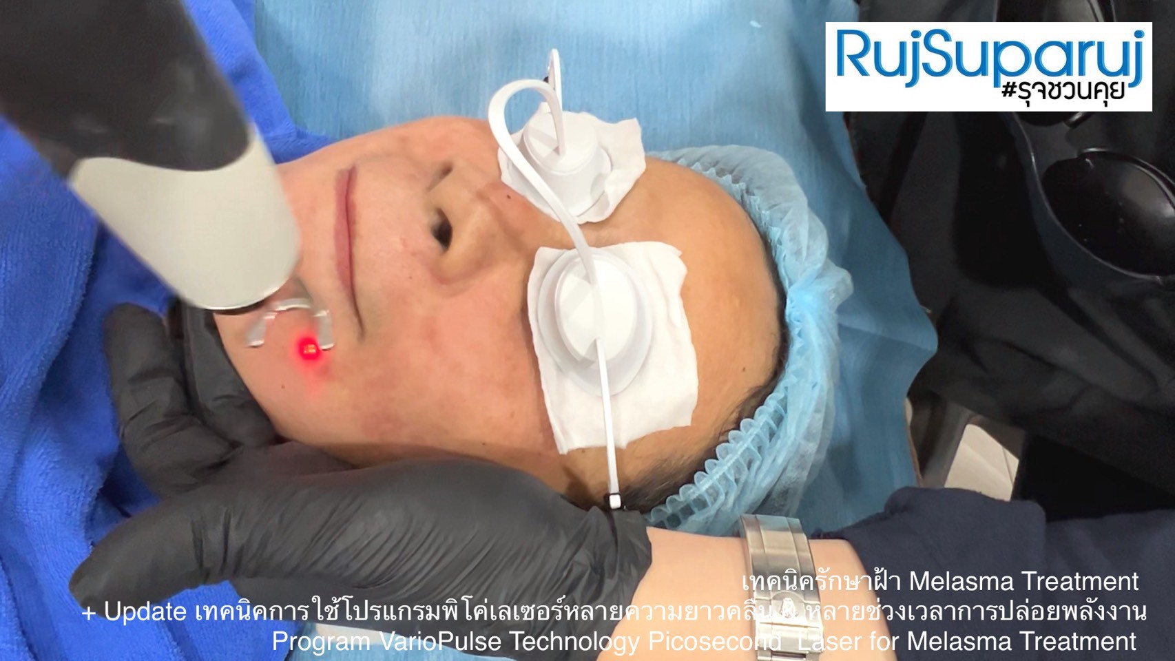Update เทคนิคดูแลปัญหาฝ้า Melasma Treatment Update