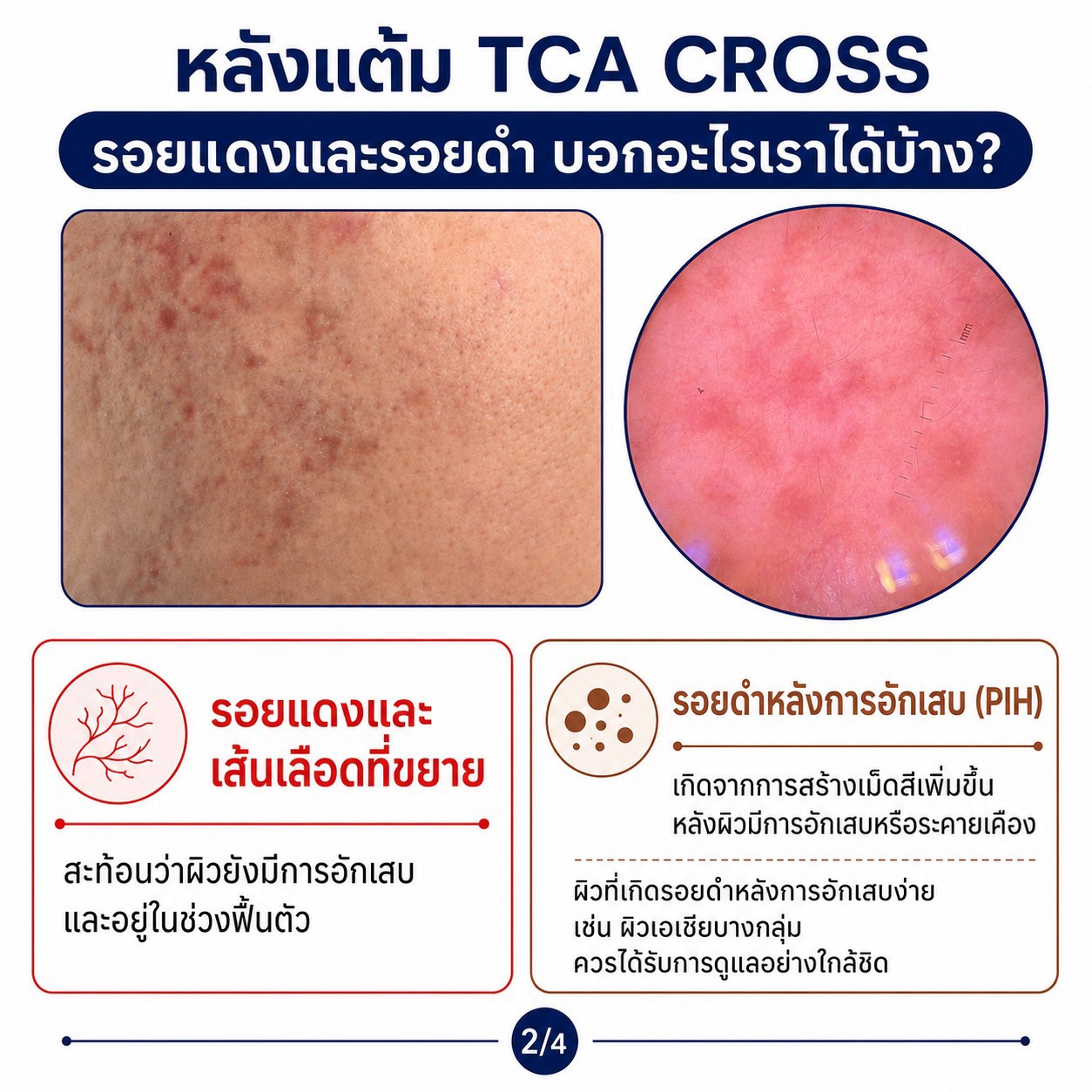แต้ม TCA CROSS รักษาหลุมสิว รอยแดงและรอยดำ บอกอะไรเราได้บ้างครับ? แต้ม TCA CROSS รักษาหลุมสิว รอยแดงและรอยดำ บอกอะไรเราได้บ้างครับ?