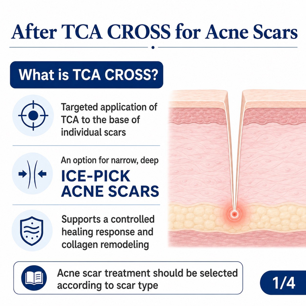 แต้ม TCA CROSS รักษาหลุมสิว รอยแดงและรอยดำ บอกอะไรเราได้บ้างครับ? แต้ม TCA CROSS รักษาหลุมสิว รอยแดงและรอยดำ บอกอะไรเราได้บ้างครับ?