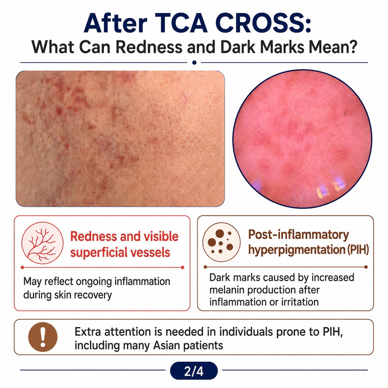 แต้ม TCA CROSS รักษาหลุมสิว รอยแดงและรอยดำ บอกอะไรเราได้บ้างครับ?