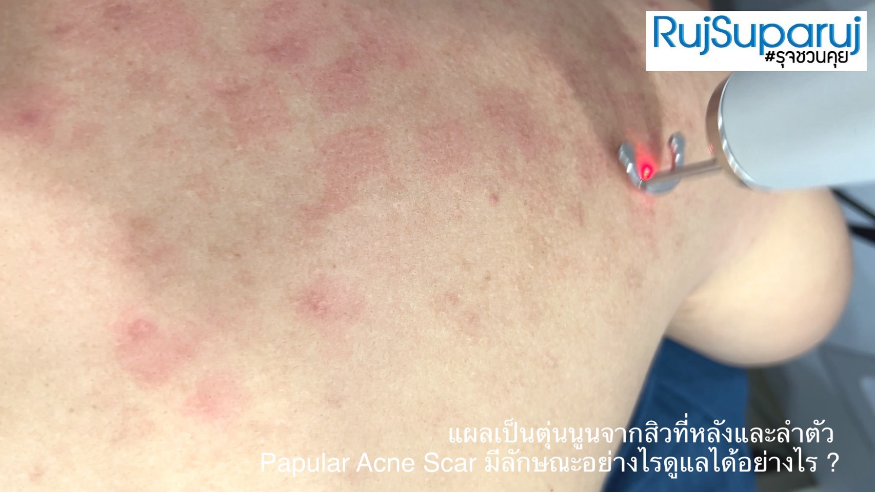 แผลเป็นตุ่นนูนจากสิวที่หลังและลำตัว Papular Acne Scar มีลักษณะอย่างไรดูแลได้อย่างไร ? แผลเป็นตุ่นนูนจากสิวที่หลังและลำตัว Papular Acne Scar มีลักษณะอย่างไรดูแลได้อย่างไร ?