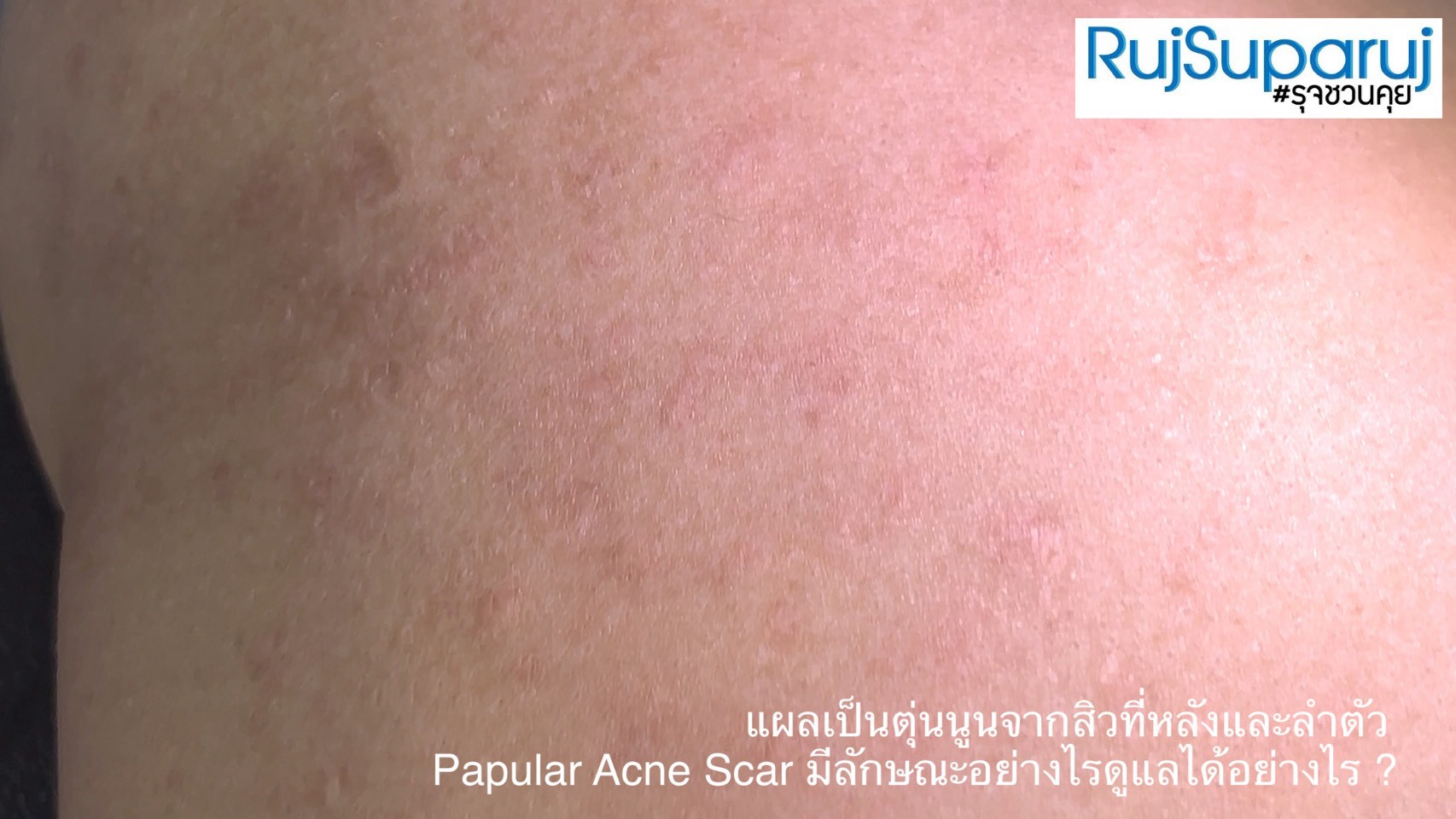 แผลเป็นตุ่นนูนจากสิวที่หลังและลำตัว Papular Acne Scar มีลักษณะอย่างไรดูแลได้อย่างไร ?