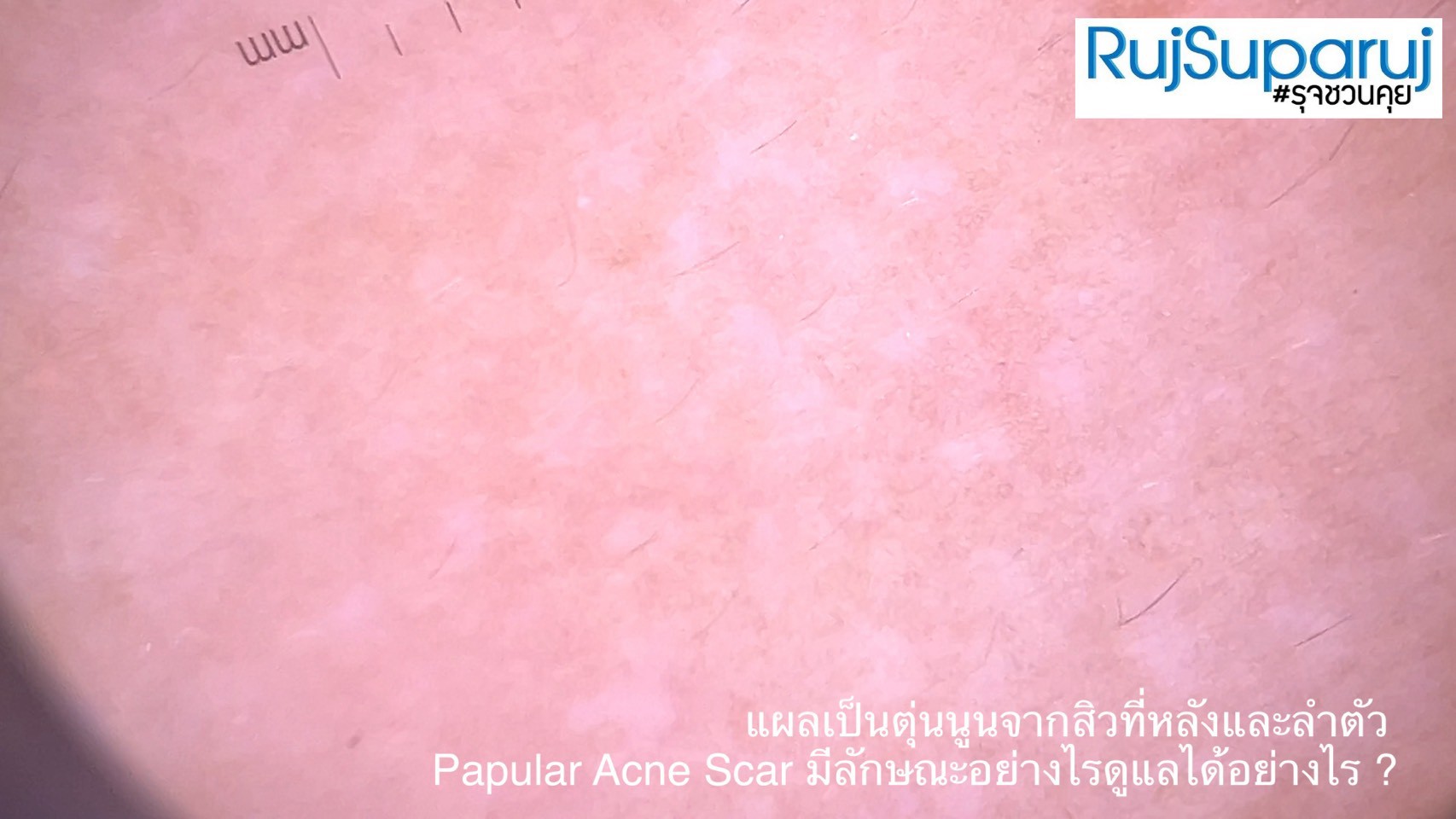 แผลเป็นตุ่นนูนจากสิวที่หลังและลำตัว Papular Acne Scar มีลักษณะอย่างไรดูแลได้อย่างไร ? แผลเป็นตุ่นนูนจากสิวที่หลังและลำตัว Papular Acne Scar มีลักษณะอย่างไรดูแลได้อย่างไร ?