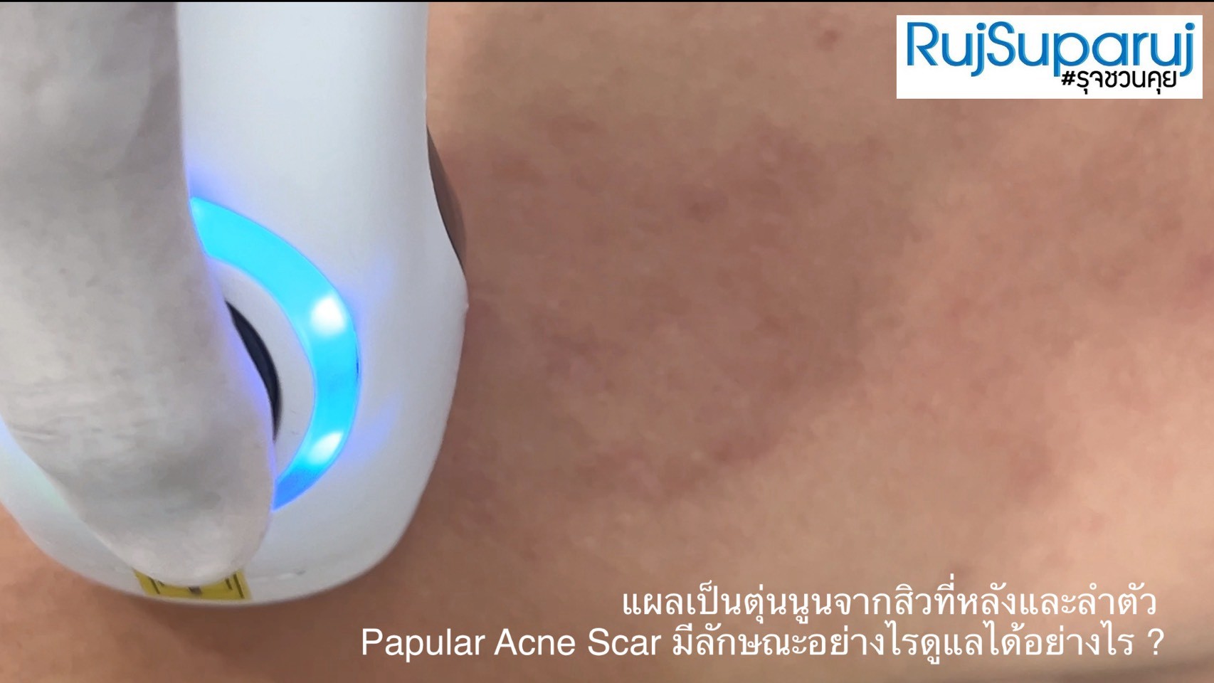 แผลเป็นตุ่นนูนจากสิวที่หลังและลำตัว Papular Acne Scar มีลักษณะอย่างไรดูแลได้อย่างไร ? แผลเป็นตุ่นนูนจากสิวที่หลังและลำตัว Papular Acne Scar มีลักษณะอย่างไรดูแลได้อย่างไร ?