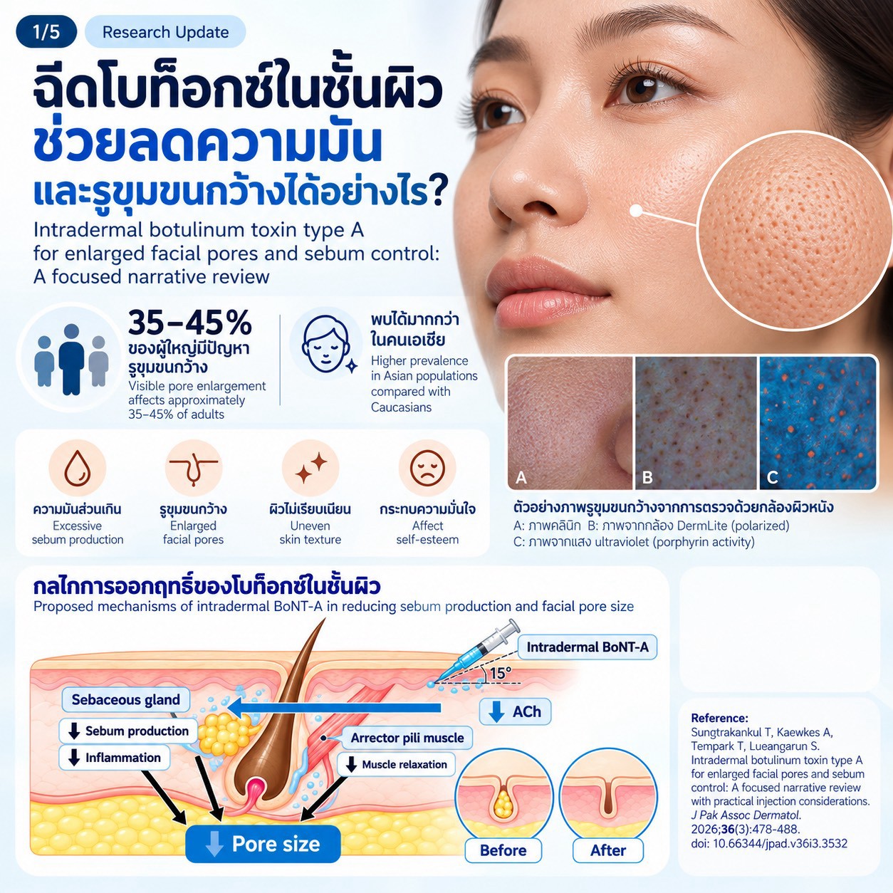 งานวิจัยทบทวน: การฉีด Botulinum Toxin Type A ในชั้นผิวเพื่อช่วยลดความมันและรูขุมขนกว้าง งานวิจัยทบทวน: การฉีด Botulinum Toxin Type A ในชั้นผิวเพื่อช่วยลดความมันและรูขุมขนกว้าง